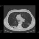Bullous emphysema: CT - Computed tomography